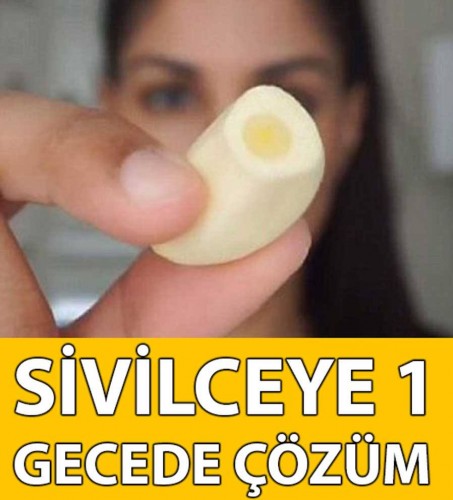 Sivilceyi 1 gecede geçiren yöntem..!