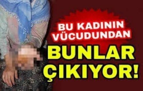 BU KADININ VÜCUDUNDAN HAYVANLAR ÇIKIYOR! KİMSE ONA İNANMADI AMA...