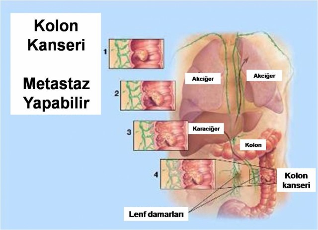 Kalın bağırsak kanserinin belirtisi Aman Dikkat!