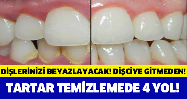 Dişçiye Gitmeden Tartar Temizlemede En Etkili 4 yol