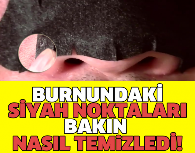 BURNUNDAKİ SİYAH NOKTALARI BAKIN NASIL TEMİZLEDİ!