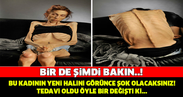 ONA BİR DE ŞİMDİ BAKIN ! TEDAVİ OLDU ŞOK DEĞİŞİM..!