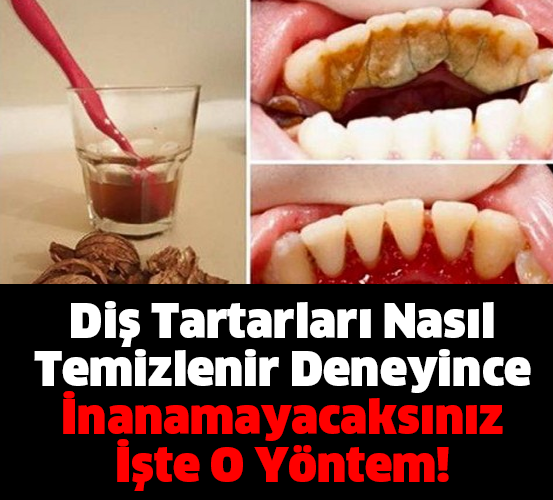 Diş Tartarları Nasıl Temizlenir Deneyince İnanamayacaksınız İşte O Yöntem!