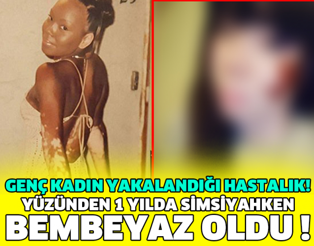 GENÇ KADIN YAKALANDIĞI HASTALIK YÜZÜNDEN 1 YILDA SİMSİYAHKEN BEMBEYAZ OLDU !