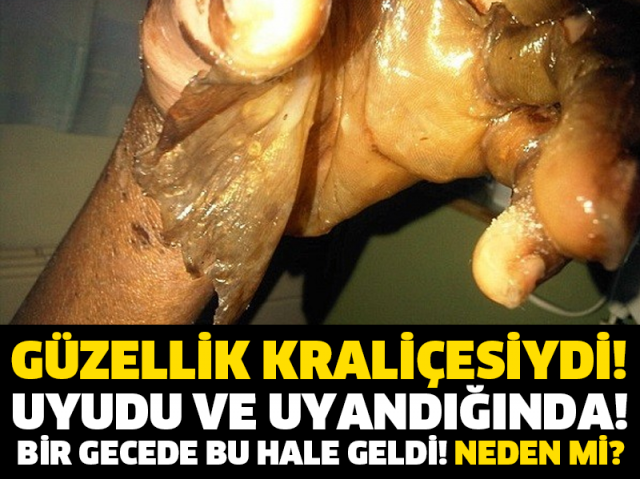 GÜZELLİK KRALİÇESİYDİ! UYUDU VE UYANDIĞINDA! BİR GECEDE BU HALE GELDİ! NEDEN Mİ?