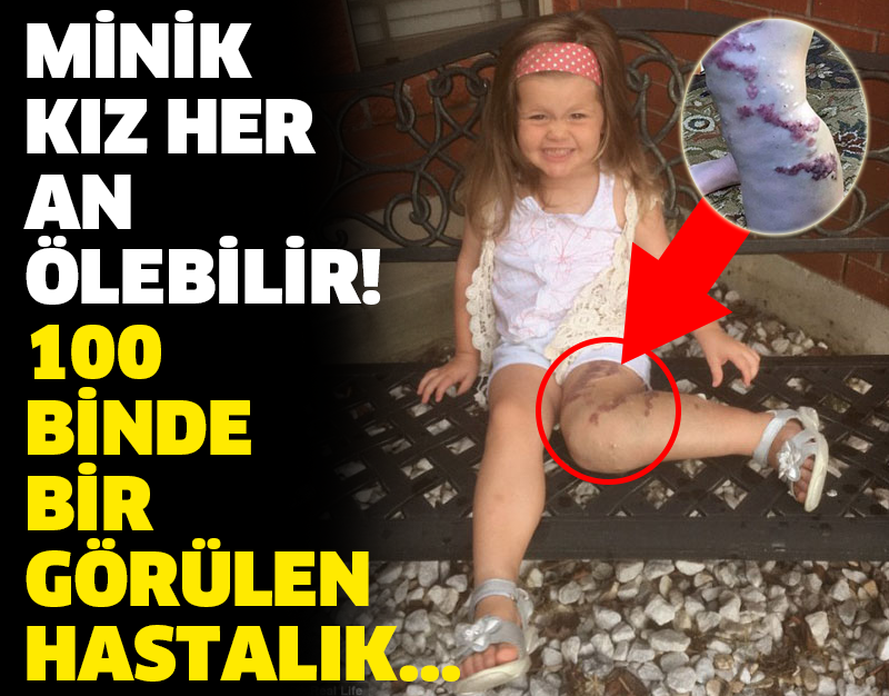 MİNİK KIZ HER AN ÖLEBİLİR! 100 BİNDE BİR GÖRÜLEN HASTALIK...