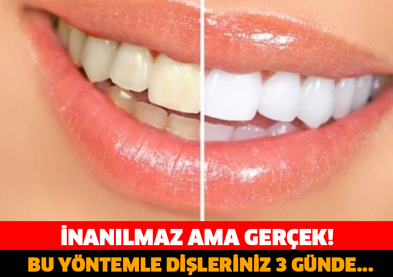 ŞOKE EDEN YÖNTEM! SADECE 3 GÜNDE DİŞLERİNİZ…