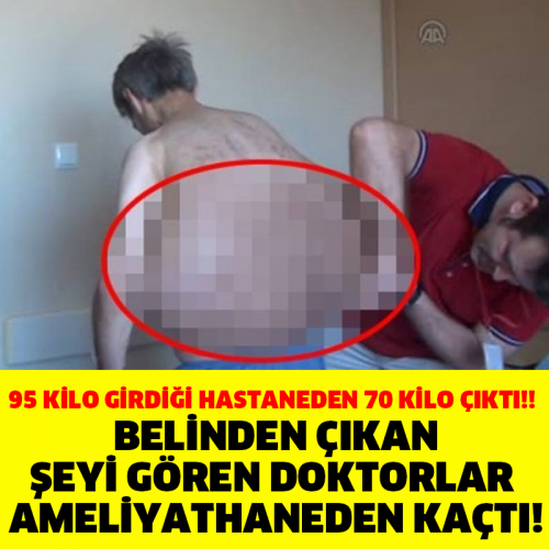 BELİNDEN ÇIKAN ŞEYİ GÖREN DOKTOR AMELİYATHANEDEN KAÇTI !