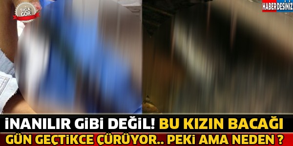 Genç Kızın Bacaği Gün Geçtikçe Çürüyor ! Peki Ama Neden ? İşte Cevabı...