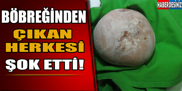 Böbreğinden Çıkan Herkesi Şok Etti!