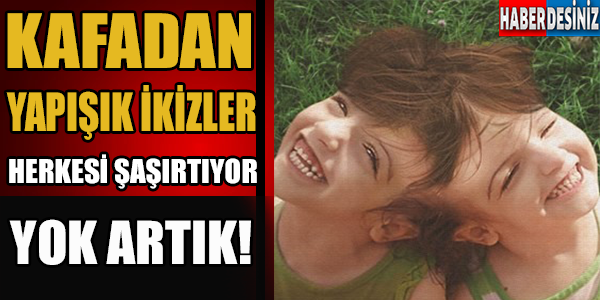 Kafadan yapışık ikizler herkesi şaşırtıyor !