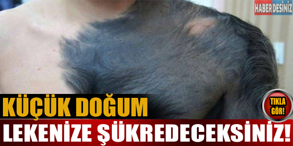 Küçük doğum lekeniz'e şükredeceksiniz!