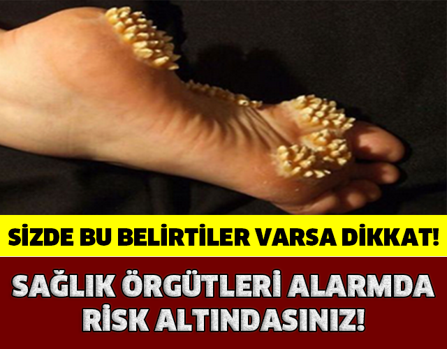 SİZDEDE BU BELİRTİLER VARSA EĞER… GÜN GEÇTİKÇE YAYILIYOR!