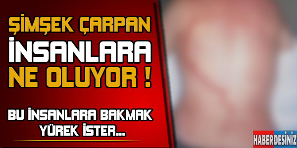 Şimşek çarpan insanlara ne oluyor ! Bu insanlara bakmak yürek ister...