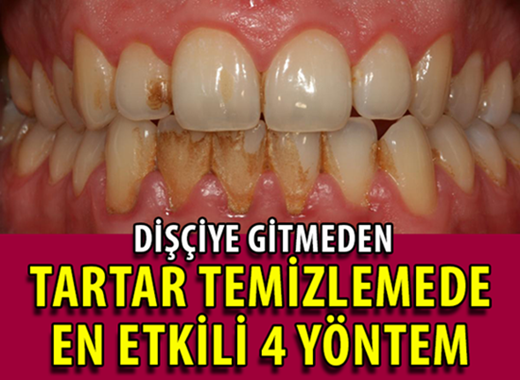 Diş Tartarını Dişçiye Gitmeden Temizleme Yöntemleri