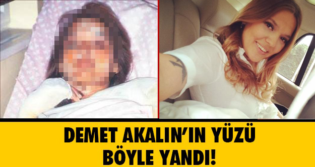 Demet Akalın Korkuttu! Yüzü İşte Böyle Yanmış..