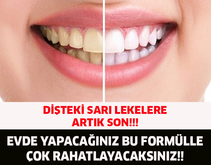 DİŞTEKİ SARI LEKELERE SON!