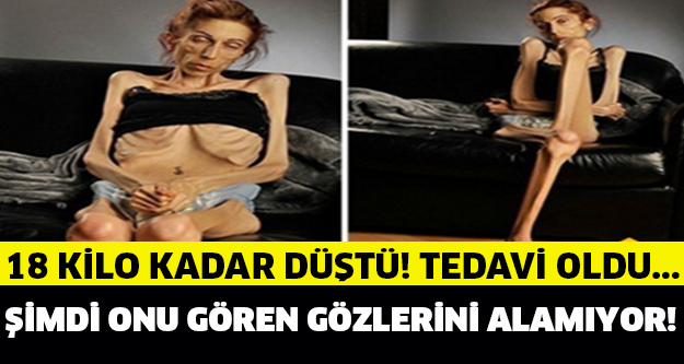 18 KİLOYA KADAR DÜŞTÜ TEDAVİ OLDU ŞİMDİ GÖZ KAMAŞTIRIYOR!