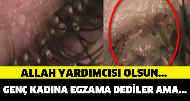 Allah yardımcısı olsun… Genç kadına egzama dediler ama… Keşke egzama olsaydı diyeceksiniz!