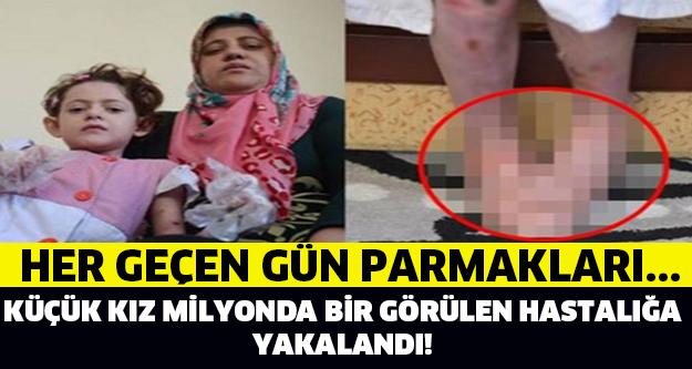 HER GEÇEN GÜN PARMAKLARI... KÜÇÜK KIZ MİLYONDA BİR GÖRÜLEN BİR HASTALIĞA YAKALANDI...