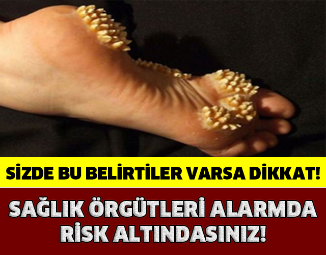 GÜN GEÇTİKÇE YAYILIYOR!EĞER SİZDE DE BU BELİRTİLER VARSA YANDINIZ!