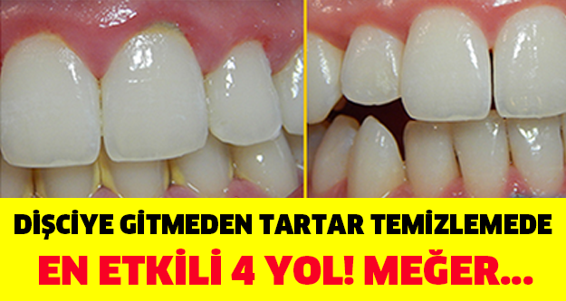 Dişçiye Gitmeden Tartar Temizlemede En Etkili 4 Yol...