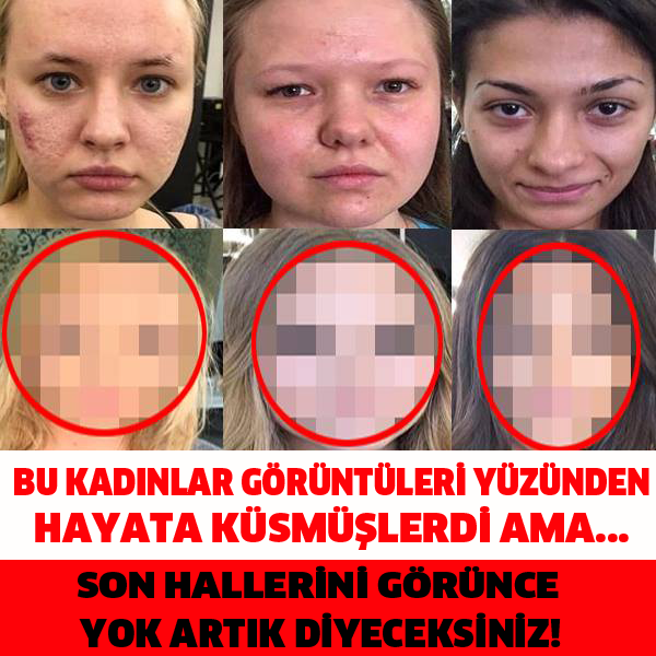 BU KADINLAR GÖRÜNTÜLERİ YÜZÜNDEN HAYATA KÜSMÜŞLERDİ AMA... SON HALLERİNİ GÖRÜNCE YOK ARTIK DİYECEKSİNİZ!