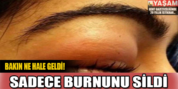 Burnunu sildi bakın ne hale geldi?