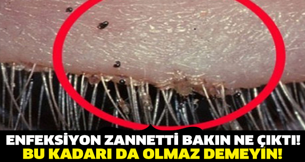 ENFEKSİYON ZANNETTİ BAKIN NE ÇIKTI ! BU KADARIDA OLMAZ DEMEYİN...