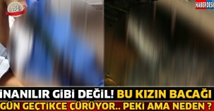 Genç Kızın Bacaği Gün Geçtikçe Çürüyor ! Peki Ama Neden ? İşte Cevabı...