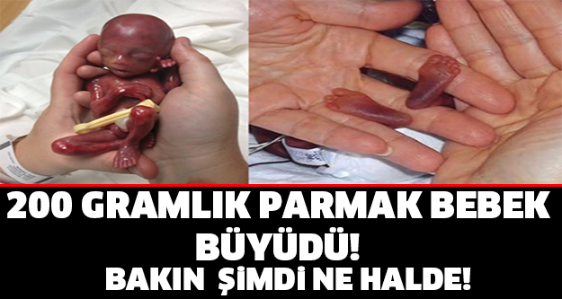 200 GRAMLIK PARMAK KIZ ARTIK BÜYÜDÜ! ŞİMDİ Kİ HALİNİ GÖRENLER MAŞALLAH DİYOR..