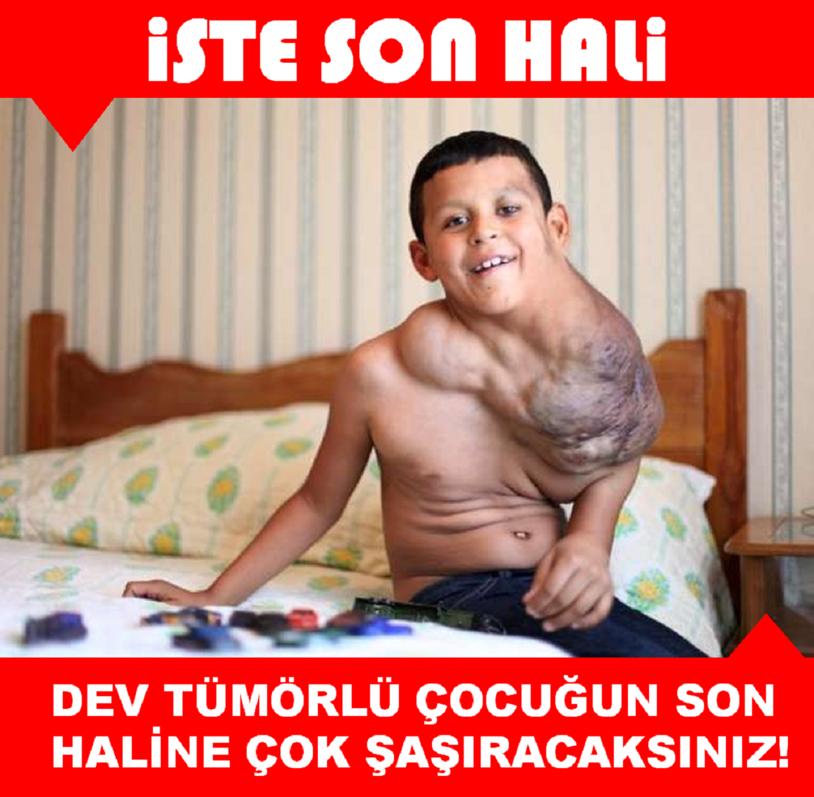 DEV TÜMÖRLÜ ÇOCUĞUN SON HALİNE ÇOK ŞAŞIRACAKSINIZ!!