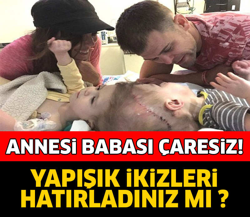 ANNE BABASI ÇARESİZ... YAPIŞIK İKİZLERİ HATIRLADINIZ MI? BAKIN ŞİMDİ NE HALDELER!